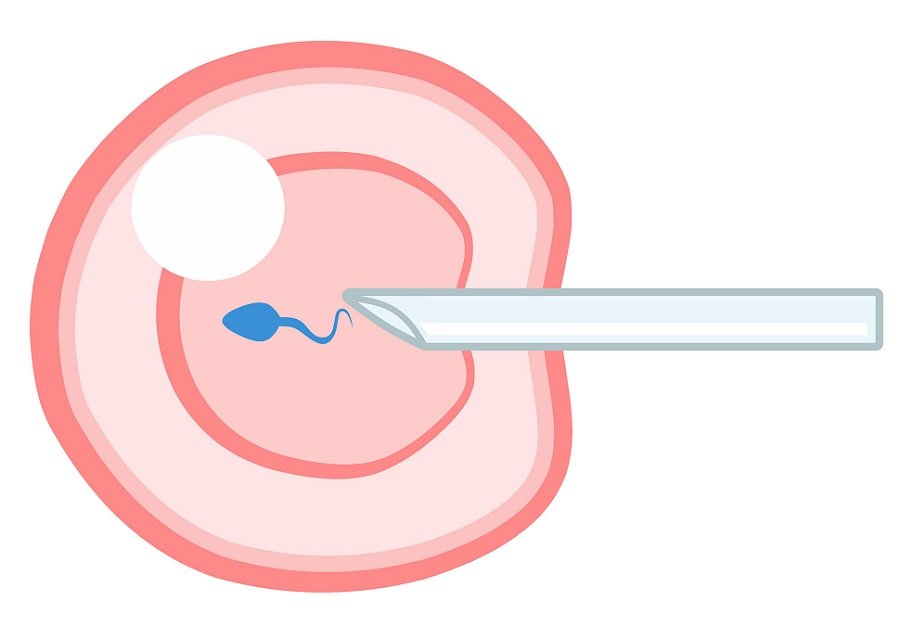How many IVF cycles are typically needed?