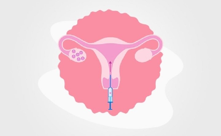 Positive Signs After Embryo Transfer: A Glance at Hope in the IVF Journey
