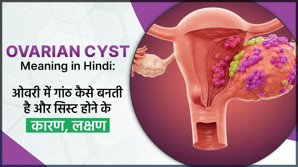 Ovarian Cyst Meaning in Hindi - ओवरी में गांठ कैसे बनती है और सिस्ट होने के कारण, लक्षण