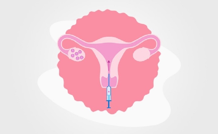 Positive Signs After Embryo Transfer: A Glance at Hope in the IVF Journey