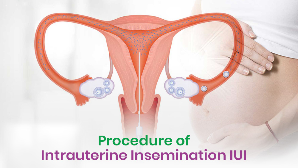 Procedure of Intrauterine Insemination (IUI)