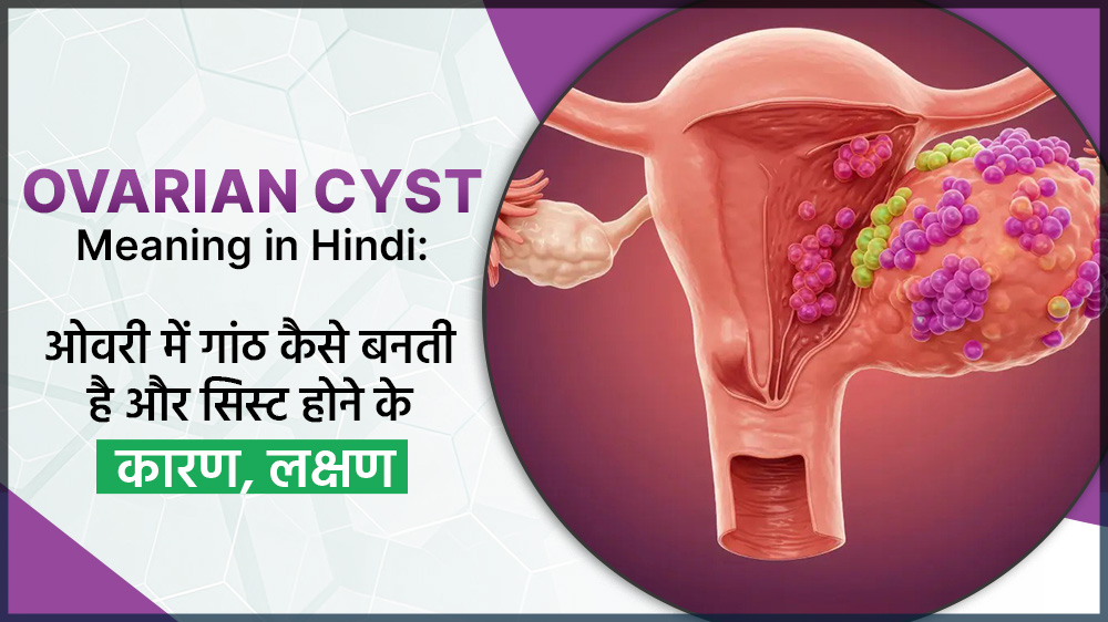 Ovarian Cyst Meaning in Hindi - ओवरी में गांठ कैसे बनती है और सिस्ट होने के कारण, लक्षण
