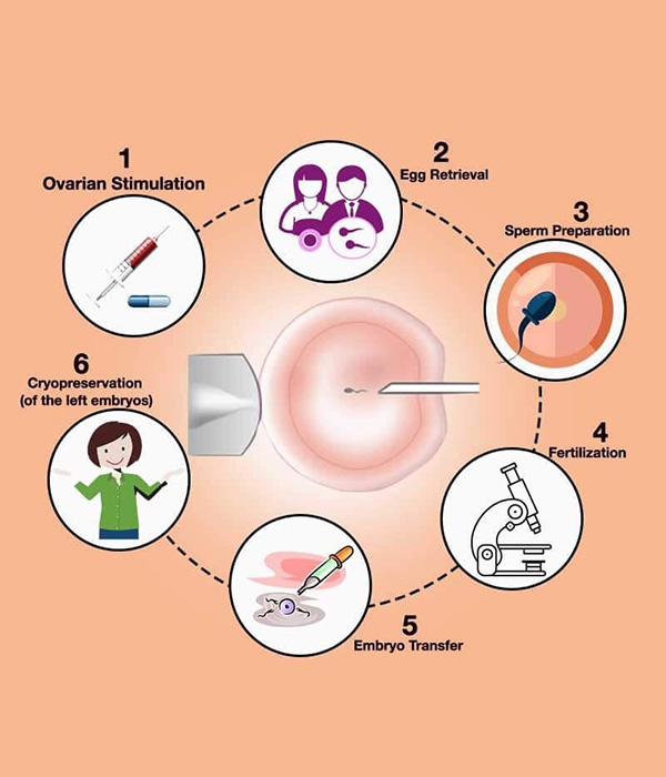 ICSI Process Step by Step