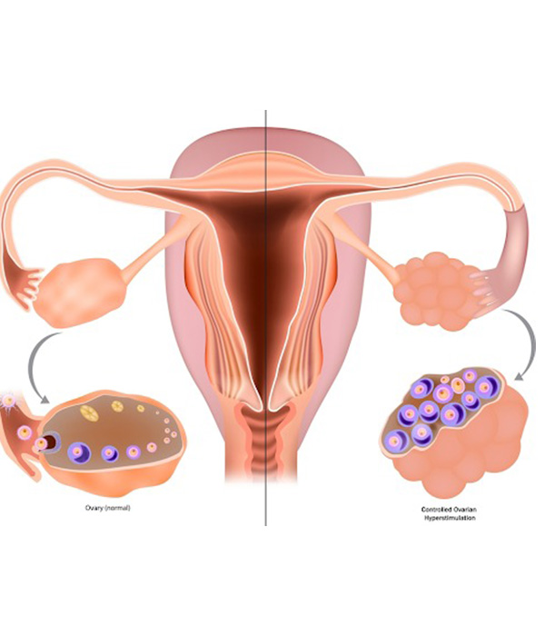 Ovarian Induction treatment Process
