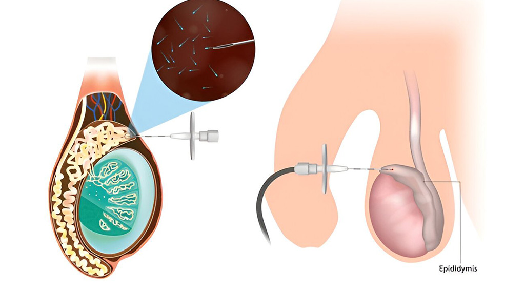 Process of Surgical Sperm Retrieval