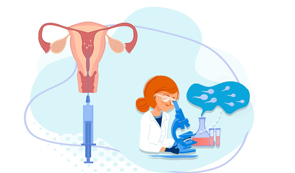 Intrauterine Insemination