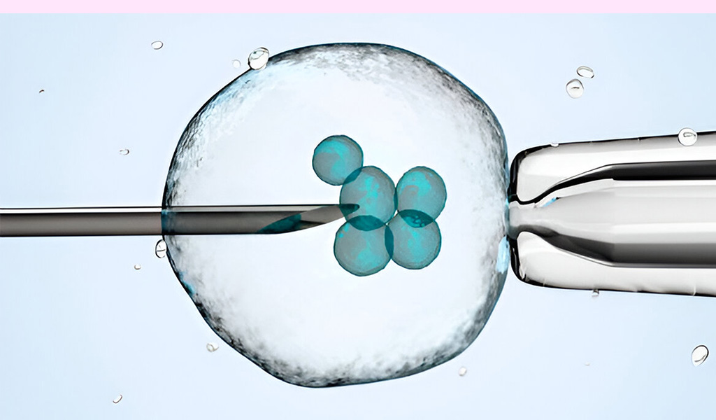 What is ICSI?