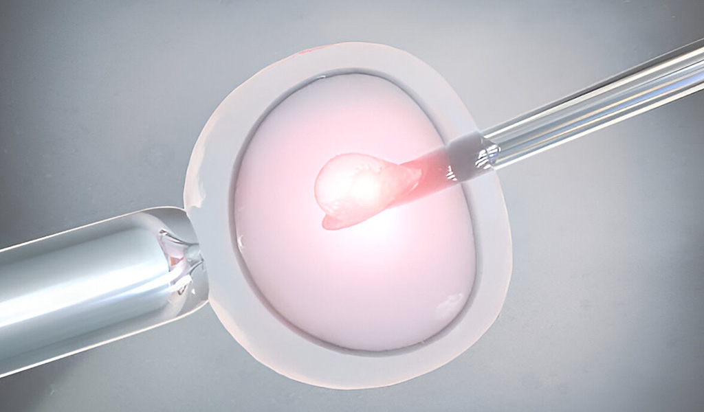 Laser Assisted Hatching (LAH): What Is It?