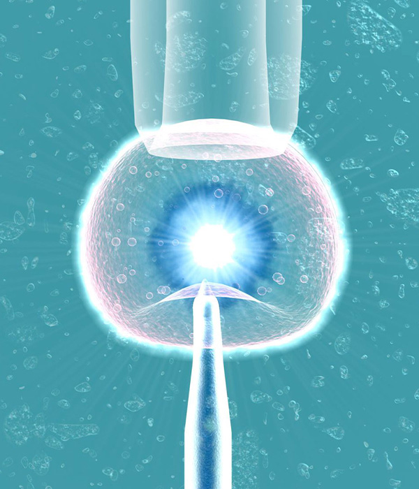 Laser Assisted Hatching process