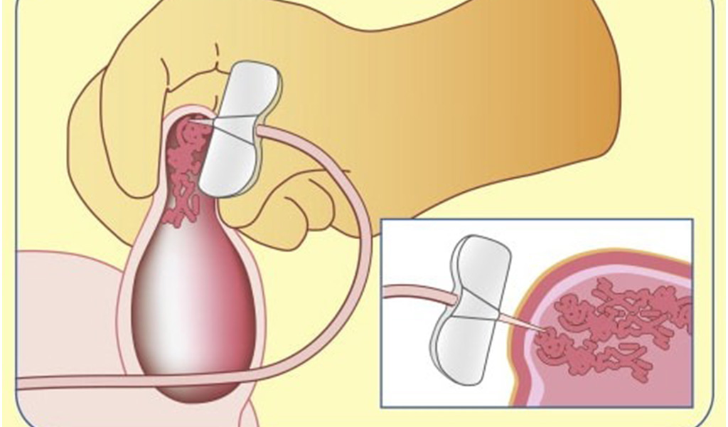 What Is Surgical Sperm Retrieval?
