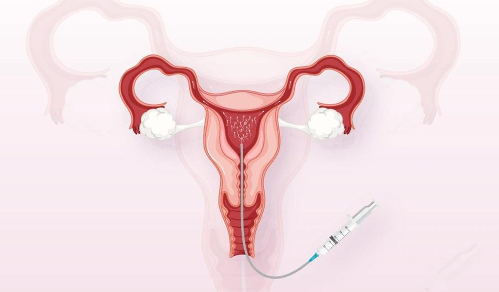 IUI Treatment 