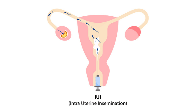 IUI For Infertility Treatment