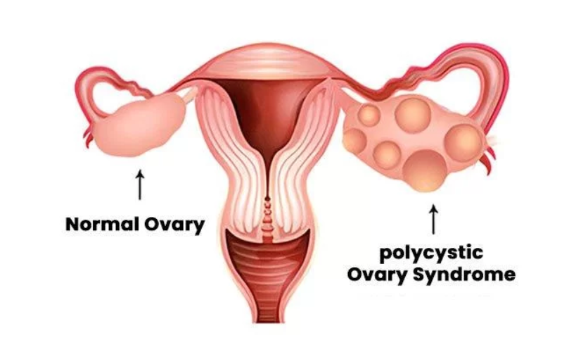 PCOS and fertility